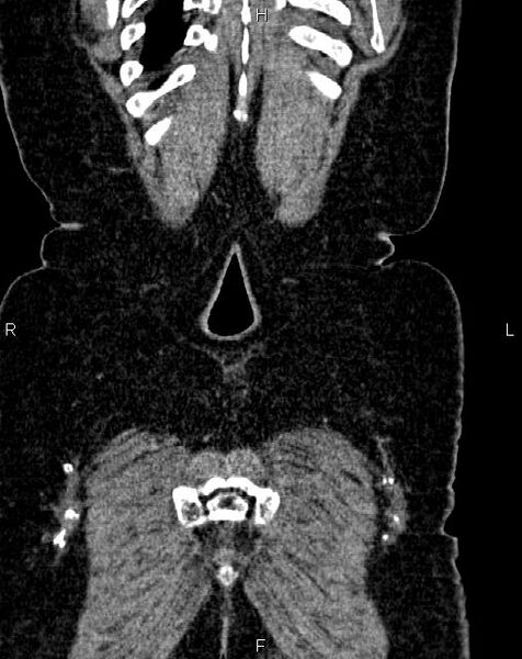 File:Bilateral ovarian serous cystadenocarcinoma (Radiopaedia 86062-101989 D 55).jpg