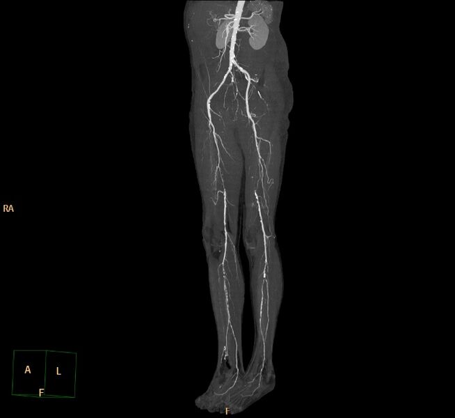 File:Bilateral superficial femoral arterial occlusion (Radiopaedia 25682-25857 3D MIP 23).jpg