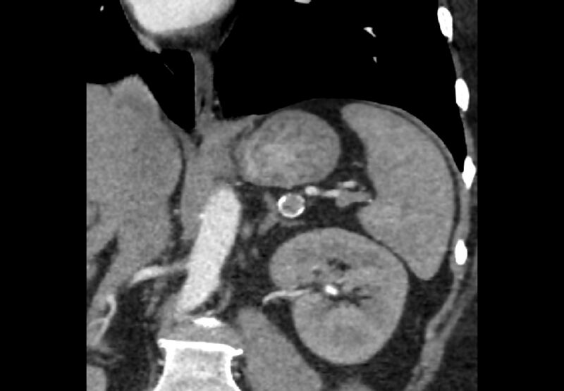 File:Bilateral urolithiasis with incidentally detected splenic artery aneurysm and left inferior vena cava (Radiopaedia 44467-48127 Ob. Cor. C+ Art. 6).jpg