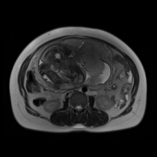 File:Bilobed placenta accreta (Radiopaedia 69648-79591 Axial T2 15).jpg