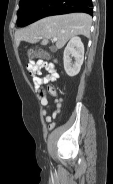 File:Bleeding duodenal ulcer and adenomyomatosis of gallbladder (Radiopaedia 61834-69861 C 27).jpg