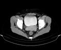 Blind-ending branch of a bifid ureter (Radiopaedia 43613-47034 A 170).jpg