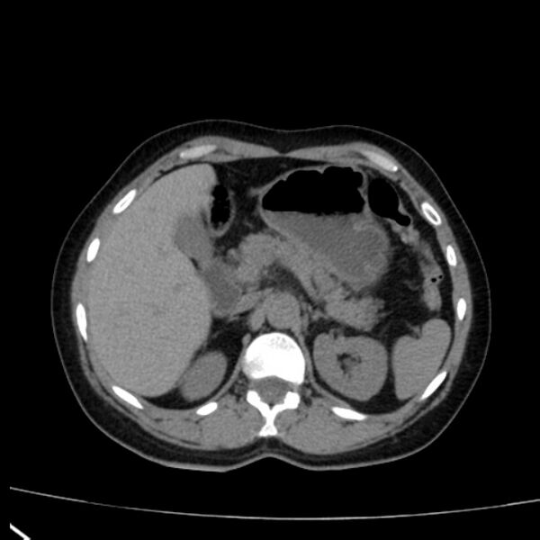 File:Bosniak renal cyst - type I (Radiopaedia 27479-27675 Axial non-contrast 25).jpg