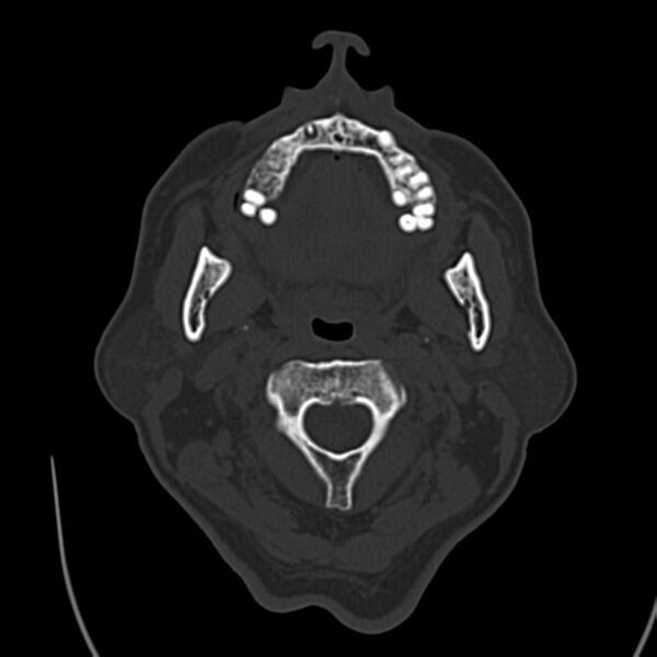 File:Brain Pantopaque remnants (Radiopaedia 78403-91048 Axial bone window 3).jpg