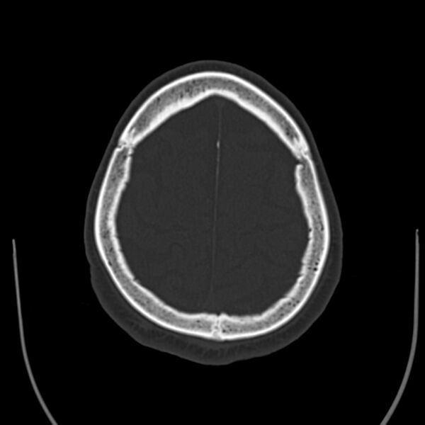 File:Brain Pantopaque remnants (Radiopaedia 78403-91048 Axial bone window 56).jpg