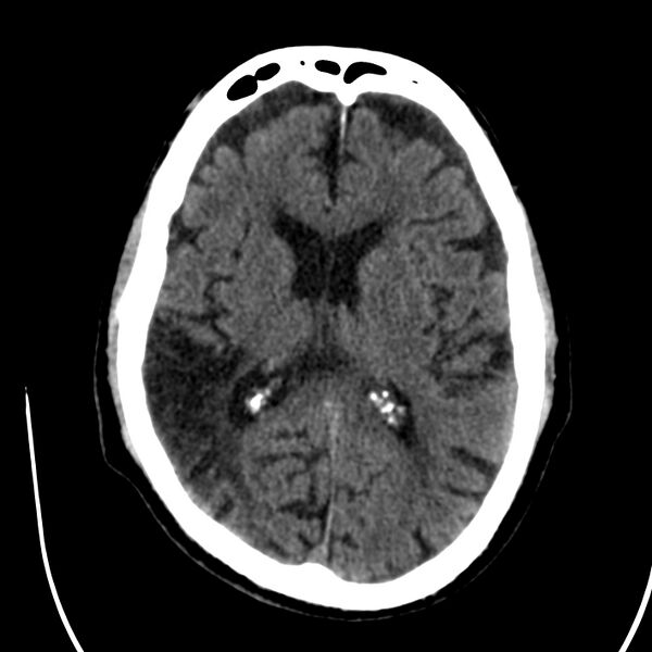 File:Brain Pantopaque remnants (Radiopaedia 78403-91048 Axial non-contrast 55).jpg
