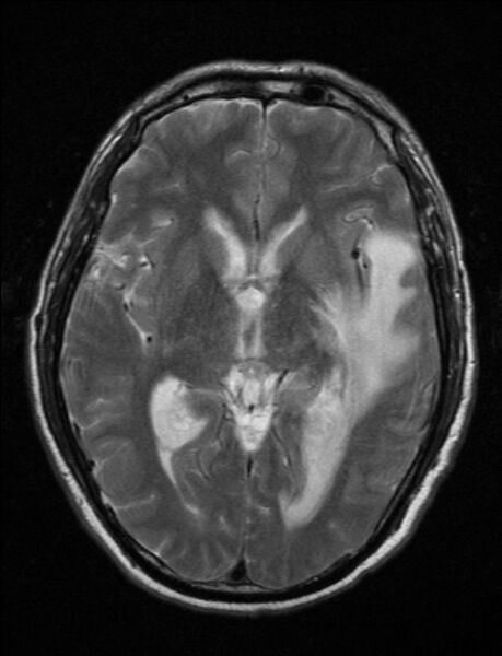 File:Brain abscess with ventriculitis (Radiopaedia 85703-101495 Axial T2 13).jpg