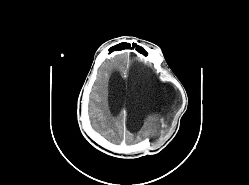 File:Brain injury by firearm projectile (Radiopaedia 82068-96088 B 154).jpg