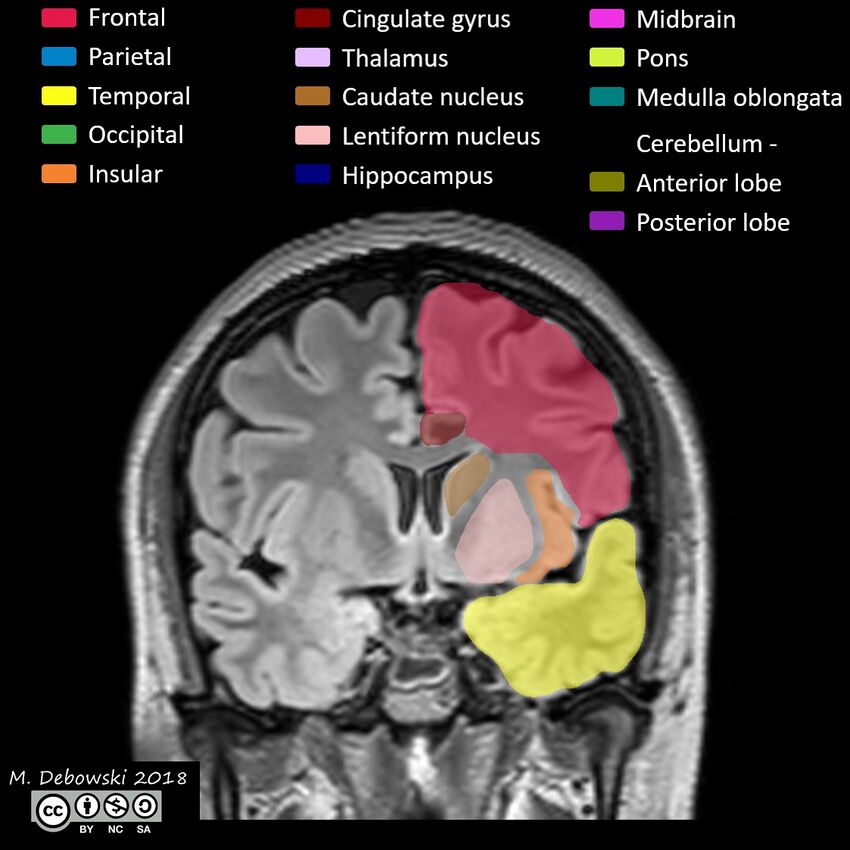 Brain lobes - annotated MRI (Radiopaedia 61691-69700 Coronal 28).JPG