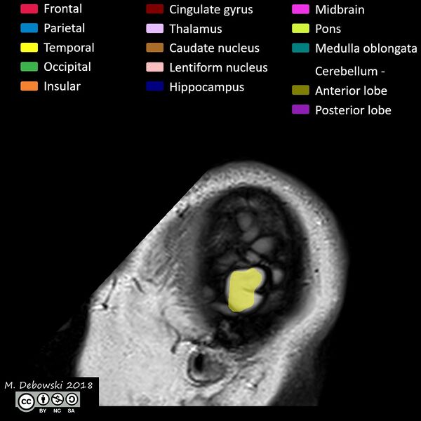 File:Brain lobes - annotated MRI (Radiopaedia 61691-69700 Sagittal 80).JPG