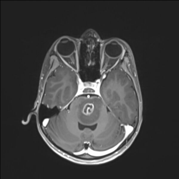 File:Brainstem glioma (Radiopaedia 70548-80674 Axial T1 C+ 52).jpg