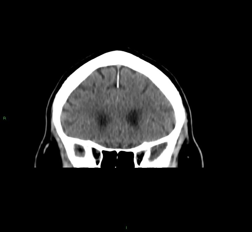 Brainstem hemorrhage (Radiopaedia 58794-66028 Coronal non-contrast 47).jpg