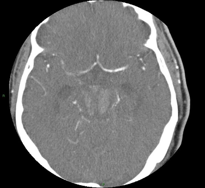 File:Brainstem hemorrhage (Radiopaedia 58794-66028 D 81).jpg