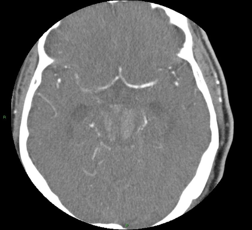Brainstem hemorrhage (Radiopaedia 58794-66028 D 81).jpg