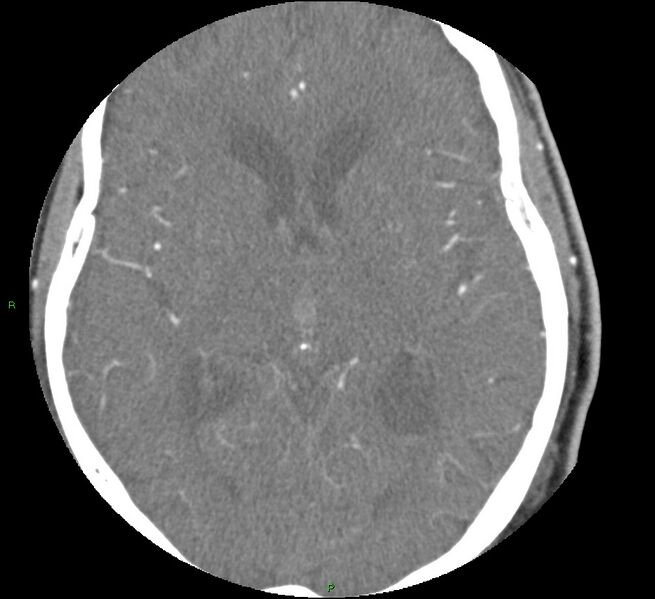 File:Brainstem hemorrhage (Radiopaedia 58794-66028 D 98).jpg