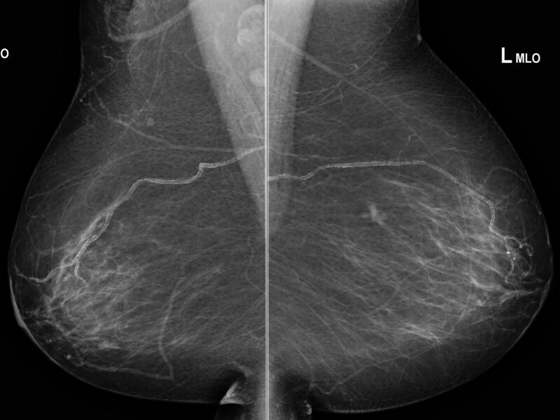 File:Breast cancer - spiculated mass occult on ultrasound (Radiopaedia 62220-70383 MLO 1).jpeg