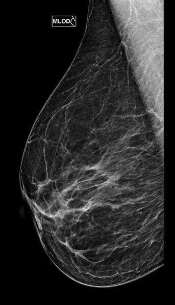 File:Breast fibroadenoma (Radiopaedia 82986-97340 MLO 1).jpg
