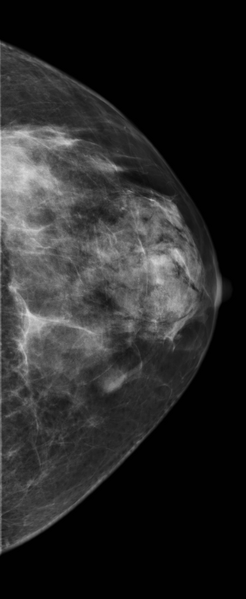 File:Breast hamartoma (Radiopaedia 23800-23942 CC 1).png