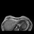 Breast implants - MRI (Radiopaedia 26864-27035 Axial T1 6).jpg