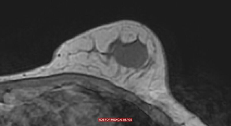File:Breast lymphoma (MRI) (Radiopaedia 34999-36498 Axial T1 19).jpg