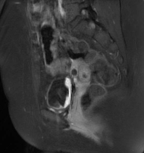 File:Broad ligament leiomyoma (Radiopaedia 81634-95516 G 12).jpg