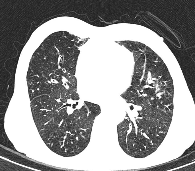 File:Bronchiolitis (Radiopaedia 24616-24887 Axial lung window 31).jpg