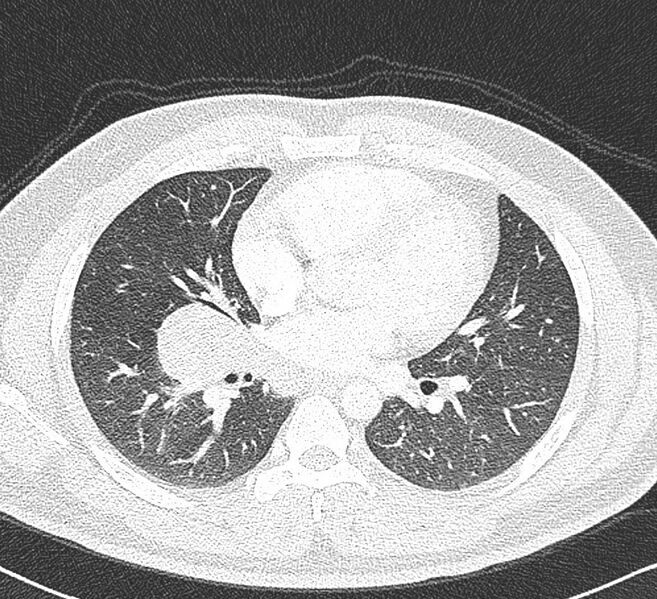 File:Bronchogenic cyst - mediastinal (Radiopaedia 19947-20149 Axial lung window 1).jpg