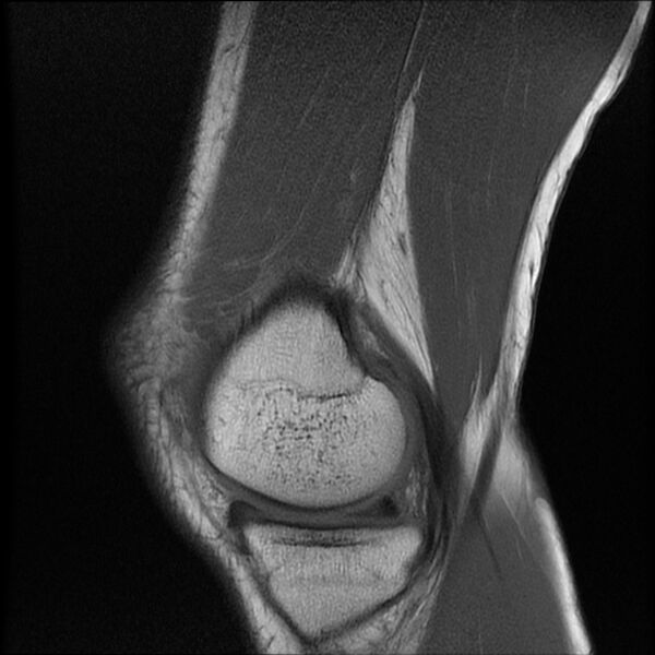 File:Bucket-handle meniscus tear (Radiopaedia 65700-74809 Sagittal T1 7).jpg