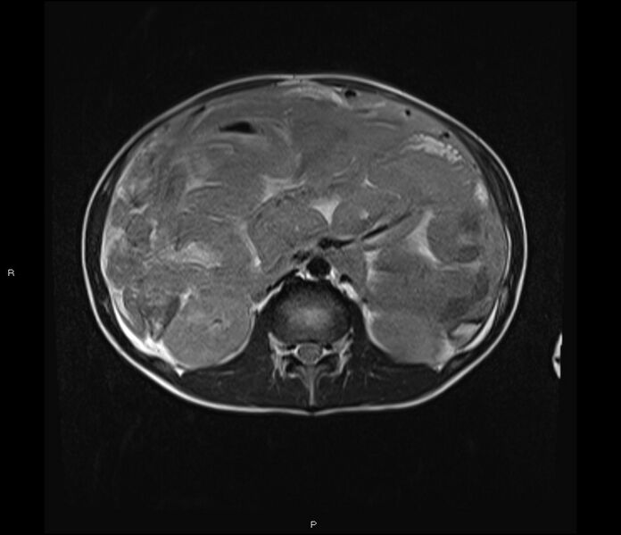 File:Burkitt lymphoma (bowel) (Radiopaedia 68839-78557 Axial T2 28).jpg