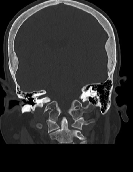 File:Burnt-out meningioma (Radiopaedia 51557-57337 Coronal bone window 30).jpg