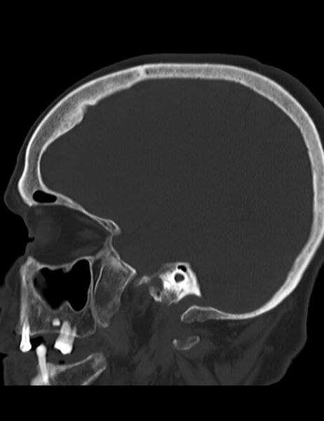 File:Burnt-out meningioma (Radiopaedia 51557-57337 Sagittal bone window 30).jpg
