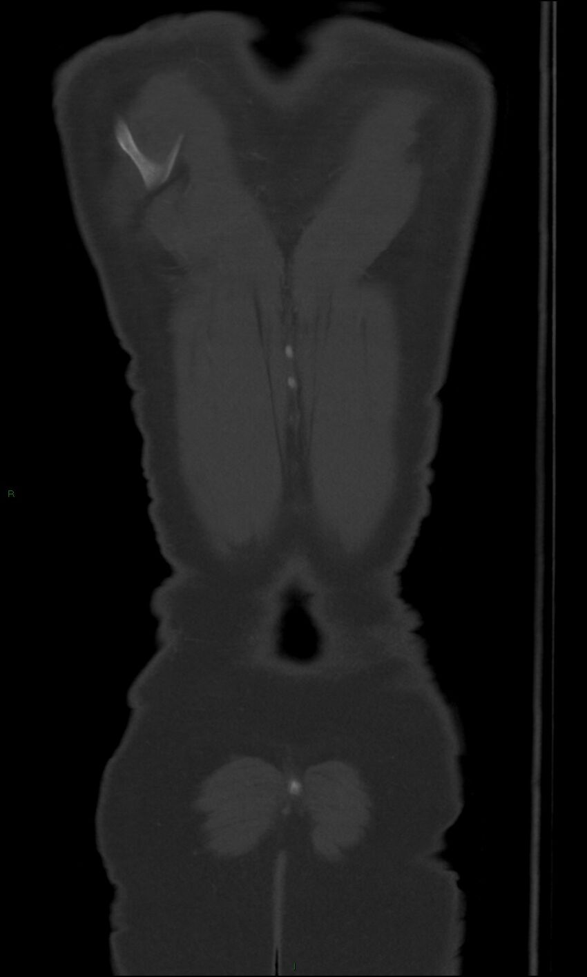 Burst fracture (Radiopaedia 83168-97542 Coronal bone window 70).jpg
