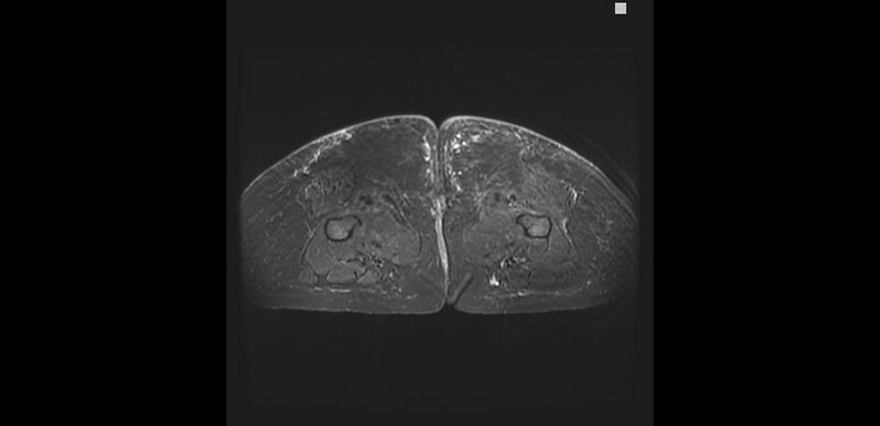File:Buttock filler complications (Radiopaedia 63497-72115 Axial STIR 30).jpg
