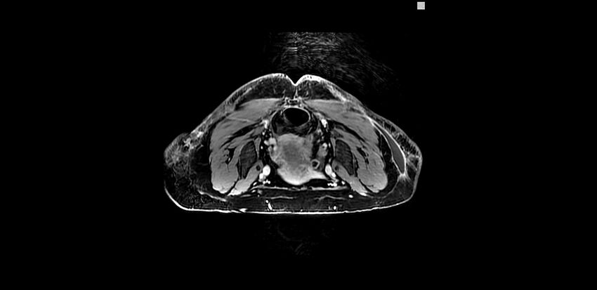 Buttock filler complications (Radiopaedia 63497-72115 Axial T1 C+ 15).jpg