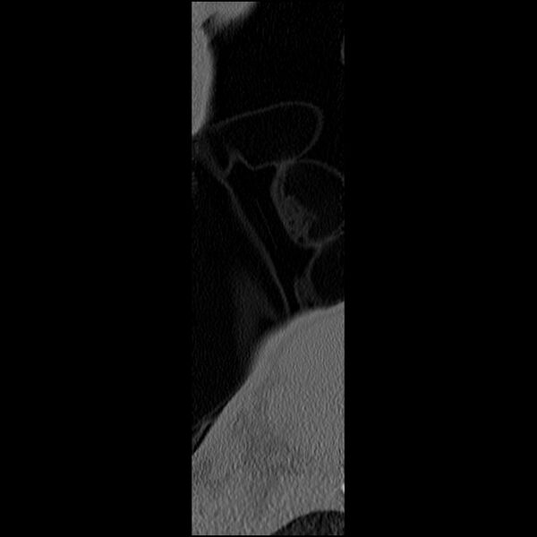 File:C5 facet fracture (Radiopaedia 58374-65499 Sagittal bone window 72).jpg