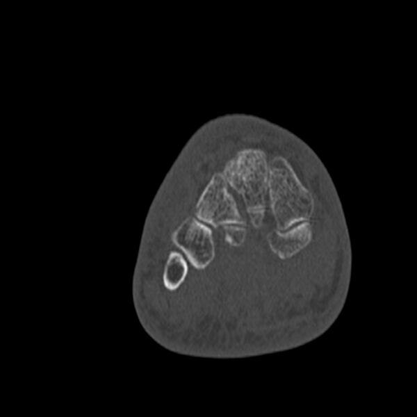 File:Calcaneal tuberosity avulsion fracture (Radiopaedia 22649-22668 Coronal bone window 35).jpg