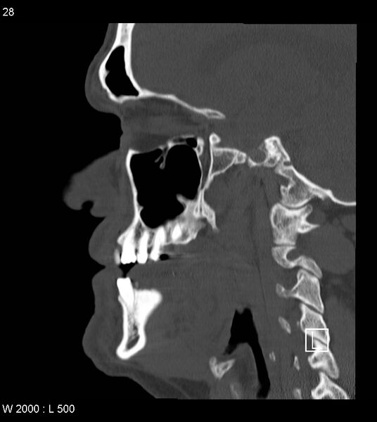 File:Calcification of the transverse band of the cruciform ligament (Radiopaedia 53063-59025 Sagittal bone window 5).jpg