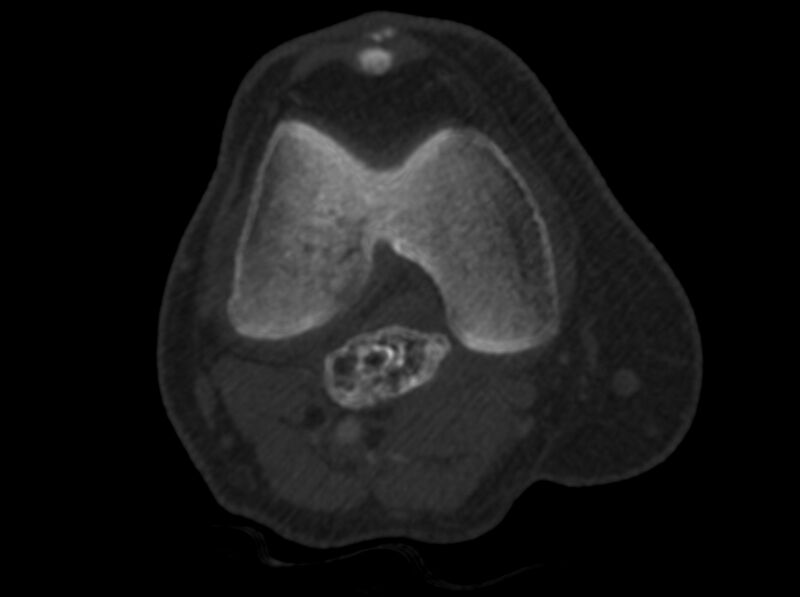 File:Calcified hematoma - popliteal fossa (Radiopaedia 63938-72763 C 11).jpg