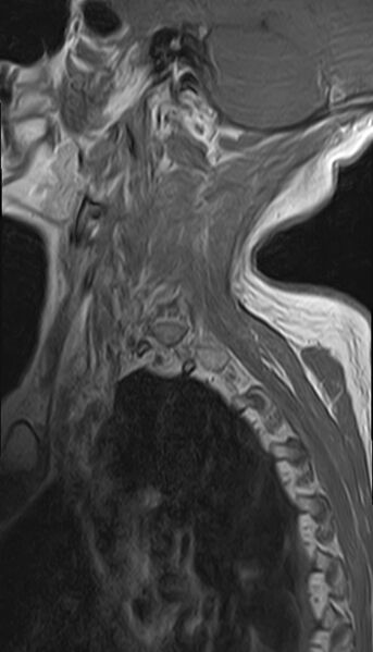 File:Calcified meningioma - cervical canal (Radiopaedia 70136-82468 Sagittal 1).jpg