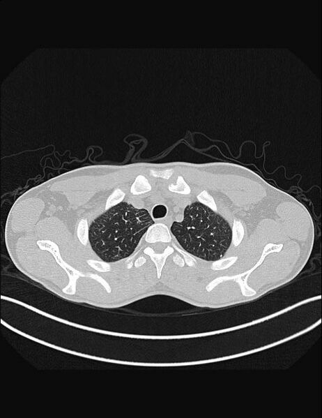 File:Calcifying pulmonary metastases (Radiopaedia 33359-34396 Axial lung window 10).jpg