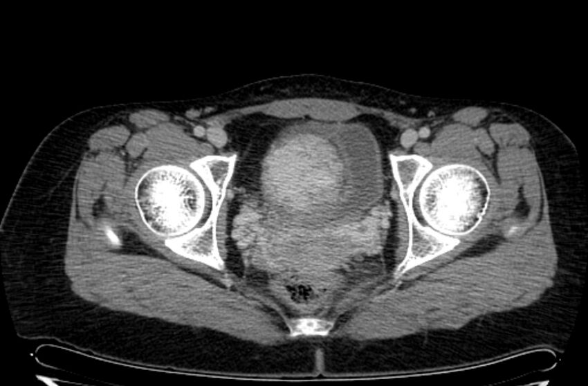 Cannonball metastases - uterine choriocarcinoma (Radiopaedia 70137-80174 A 46).jpg
