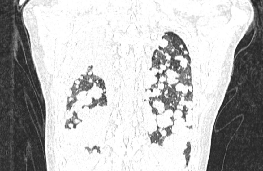 Cannonball metastases from breast cancer (Radiopaedia 91024-108569 Coronal lung window 126).jpg