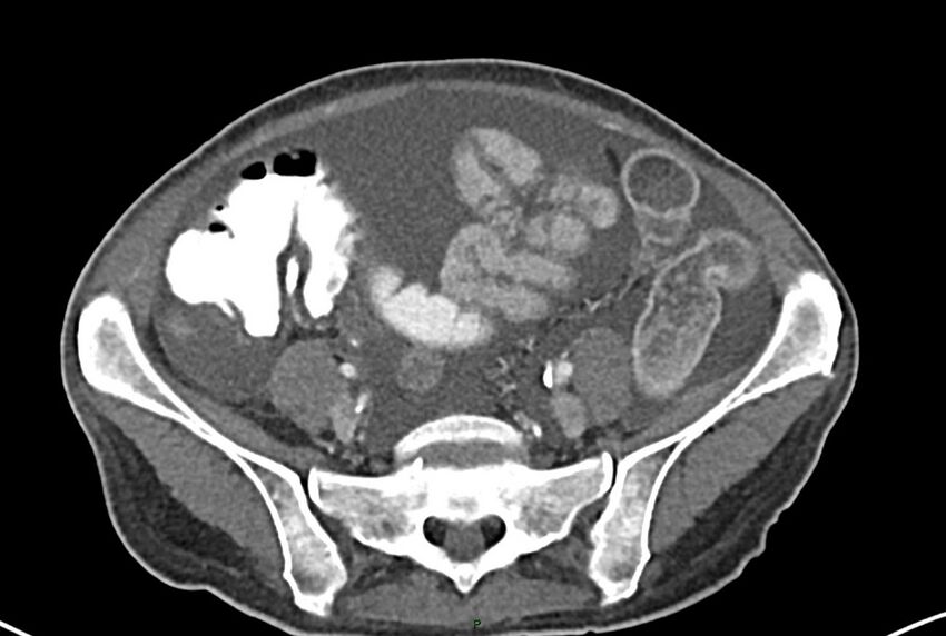 Carcinoid mesenteric tumor complicated by chylous ascites (Radiopaedia 76312-87953 A 54).jpg
