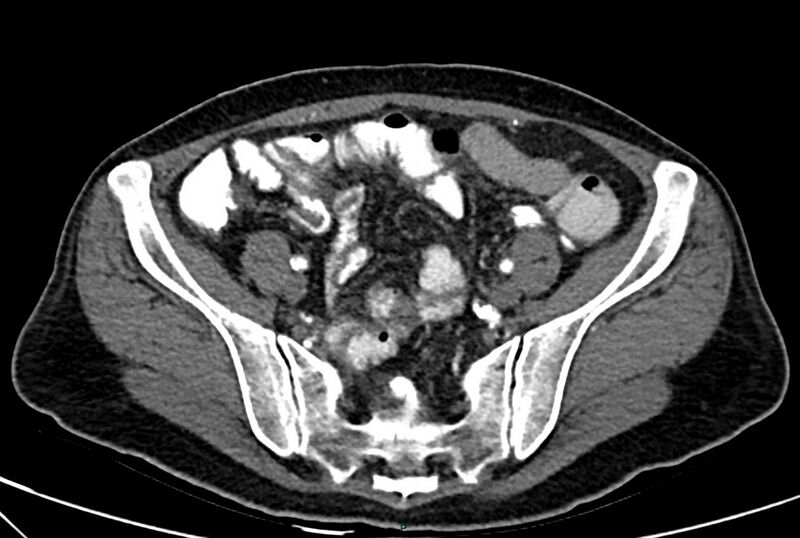 File:Carcinoid mesenteric tumor complicated by chylous ascites (Radiopaedia 76312-88926 A 56).jpg