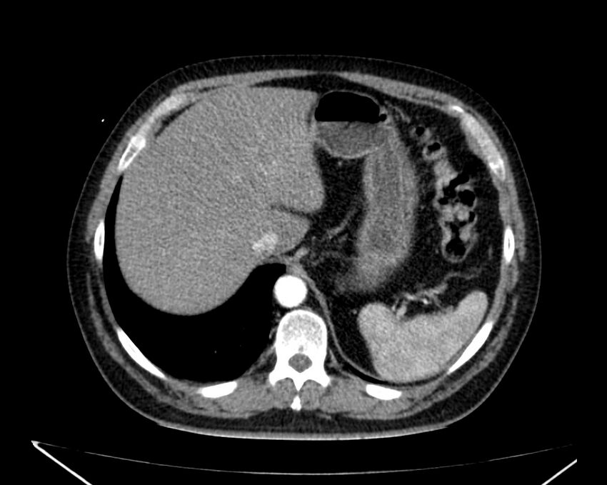 Carcinoid tumor with hepatic metastases (Radiopaedia 22651-22670 B 17).jpg