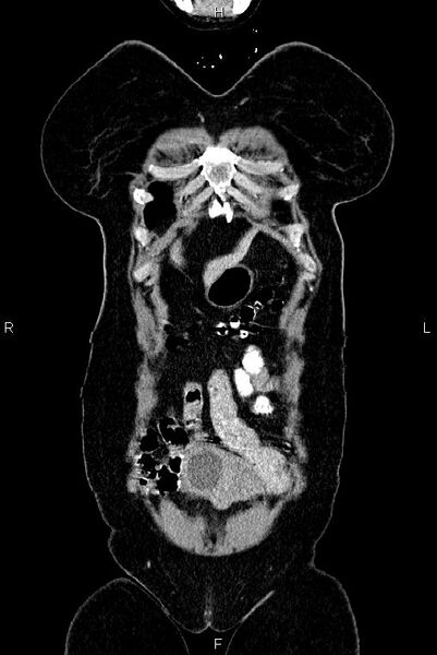 File:Carcinoma of uterine cervix (Radiopaedia 85861-101700 C 1).jpg