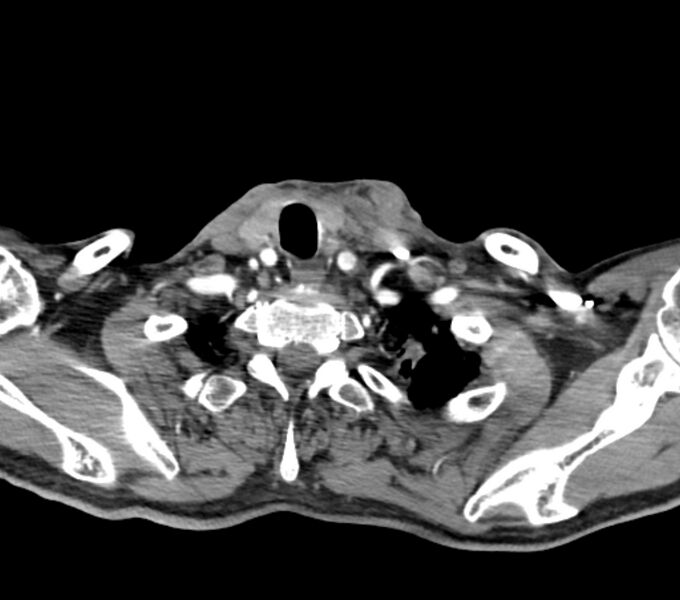 File:Carotid artery pseudoaneurysm - left (Radiopaedia 84030-99259 Axial 116).jpg