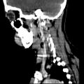 Carotid body tumor (Radiopaedia 27890-28124 C 5).jpg
