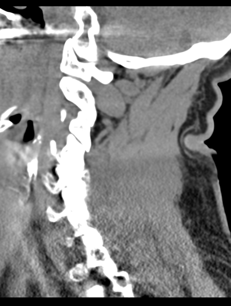 File:Cavernoma of cervical cord (Radiopaedia 50838-56346 B 29).png