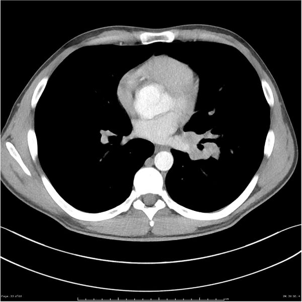 File:Cavitating lung cancer (Radiopaedia 25796-25945 C+ arterial phase 33).jpg